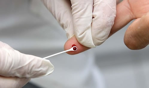 HIV