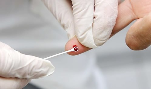 HIV